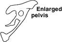 enlarged pelvis
